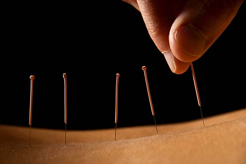 Akupunkturnadeln zur Behandlung von Beschwerden