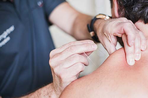 Triggerakupunktur löst Verspannung und hilft bei der Behandlung von Nackenschmerzen
