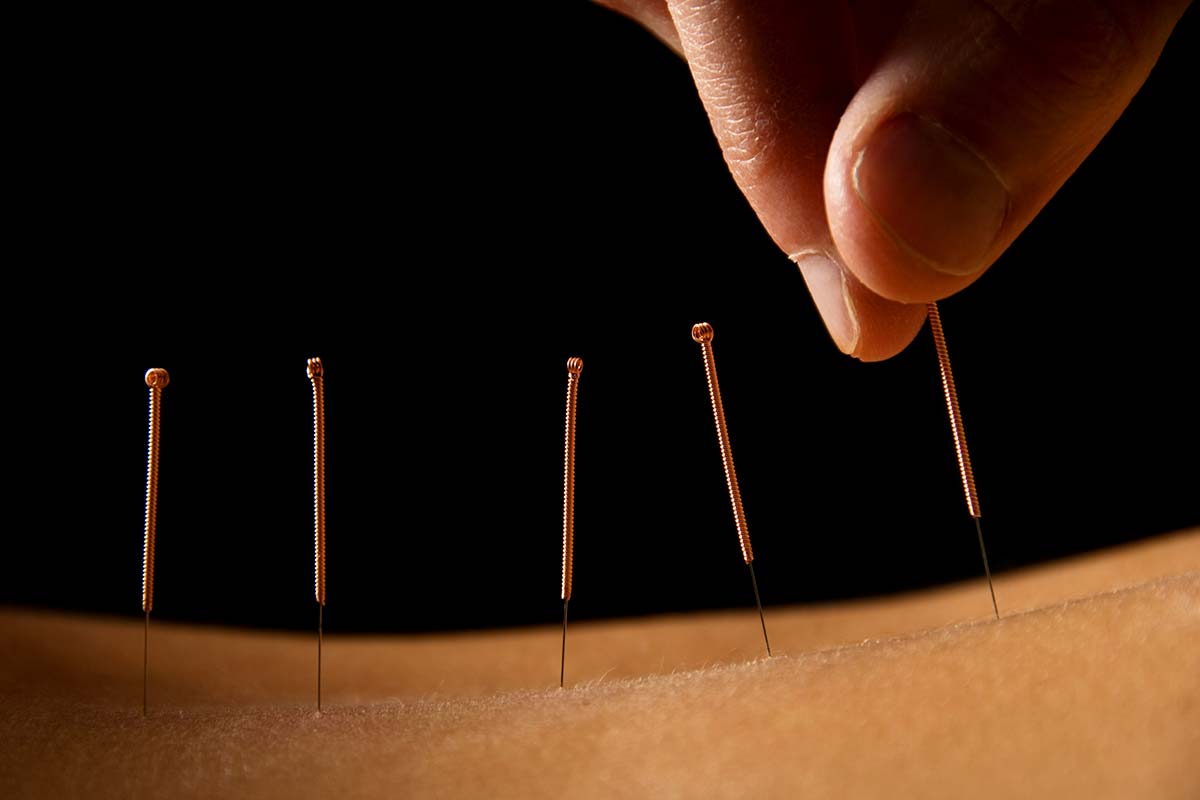 Ischiasbeschwerden – Triggerpunktakupunktur