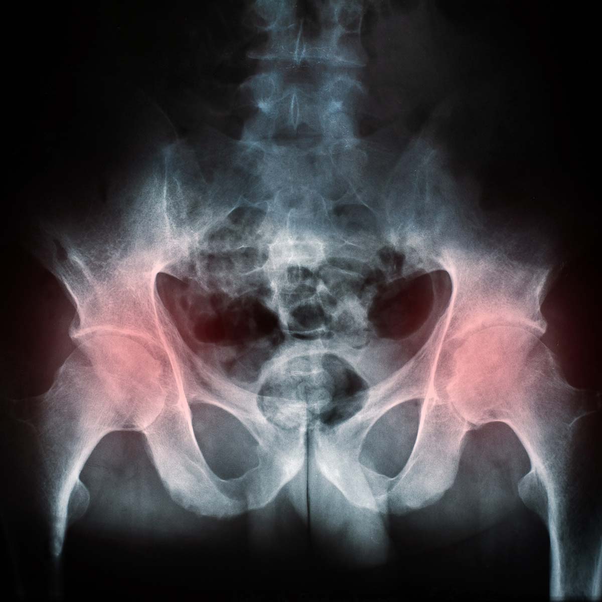 Röntgen Darstellung der Hüfte – Leistenschmerzen