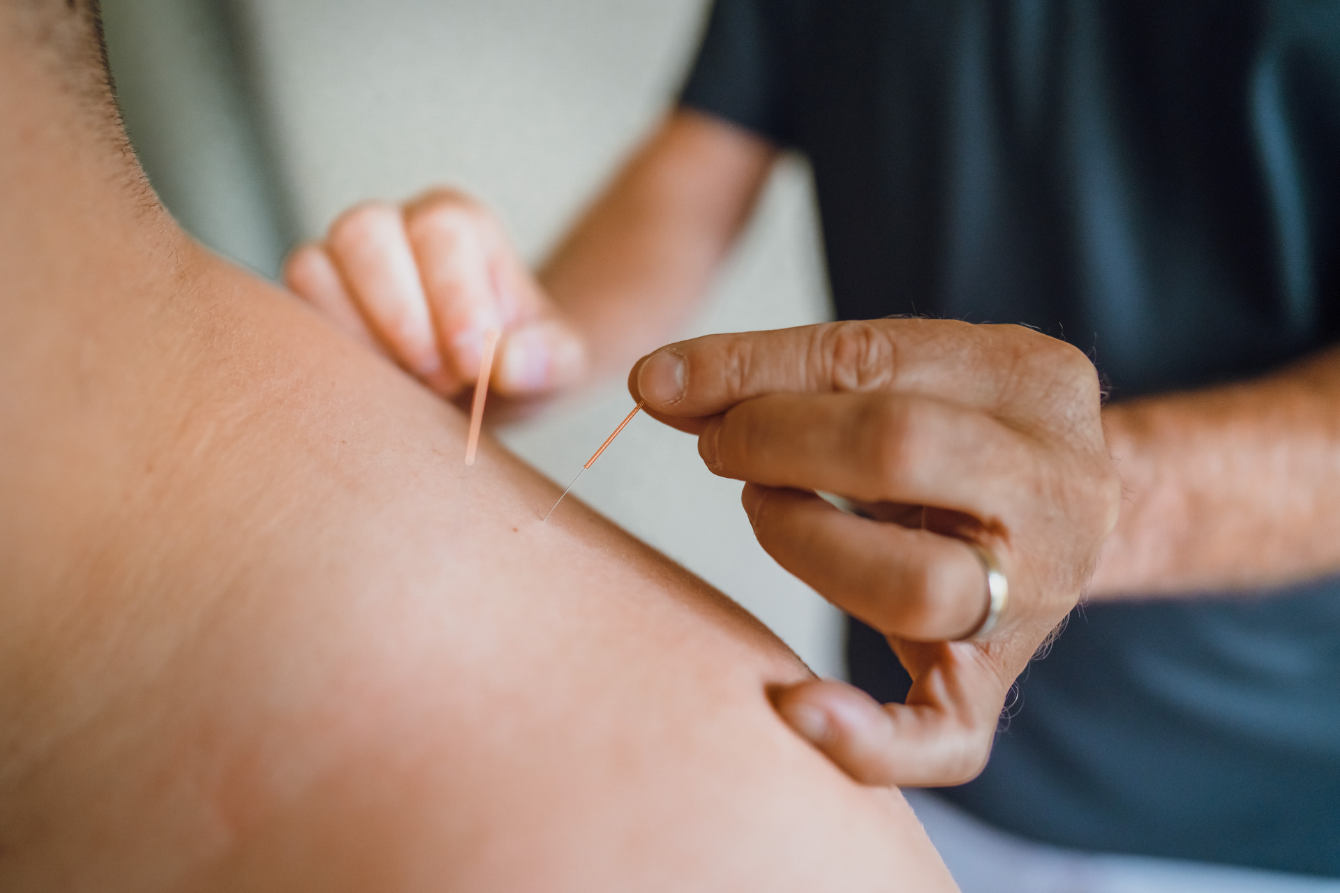 Triggerpunktakupunktur im Orthozentrum Bergstraße